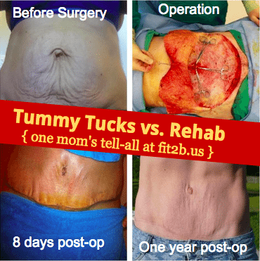 If you have a diastasis recti (split in your abs) should you do rehab or get a tummy tuck? One more who did both tells all at fit2b.us