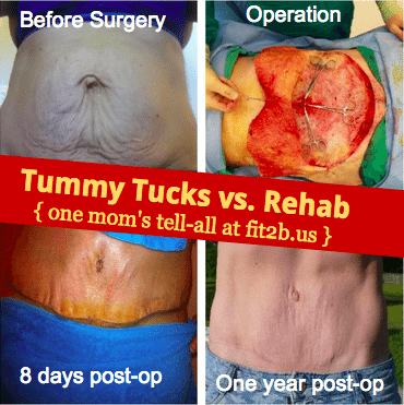 Diastasis and Tummy Tucks vs. Abdominal Rehab