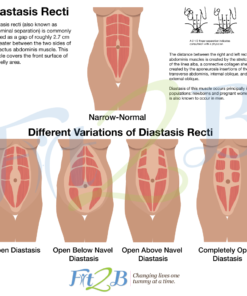 different types of diastasis rectus abdominus - fit2b.com