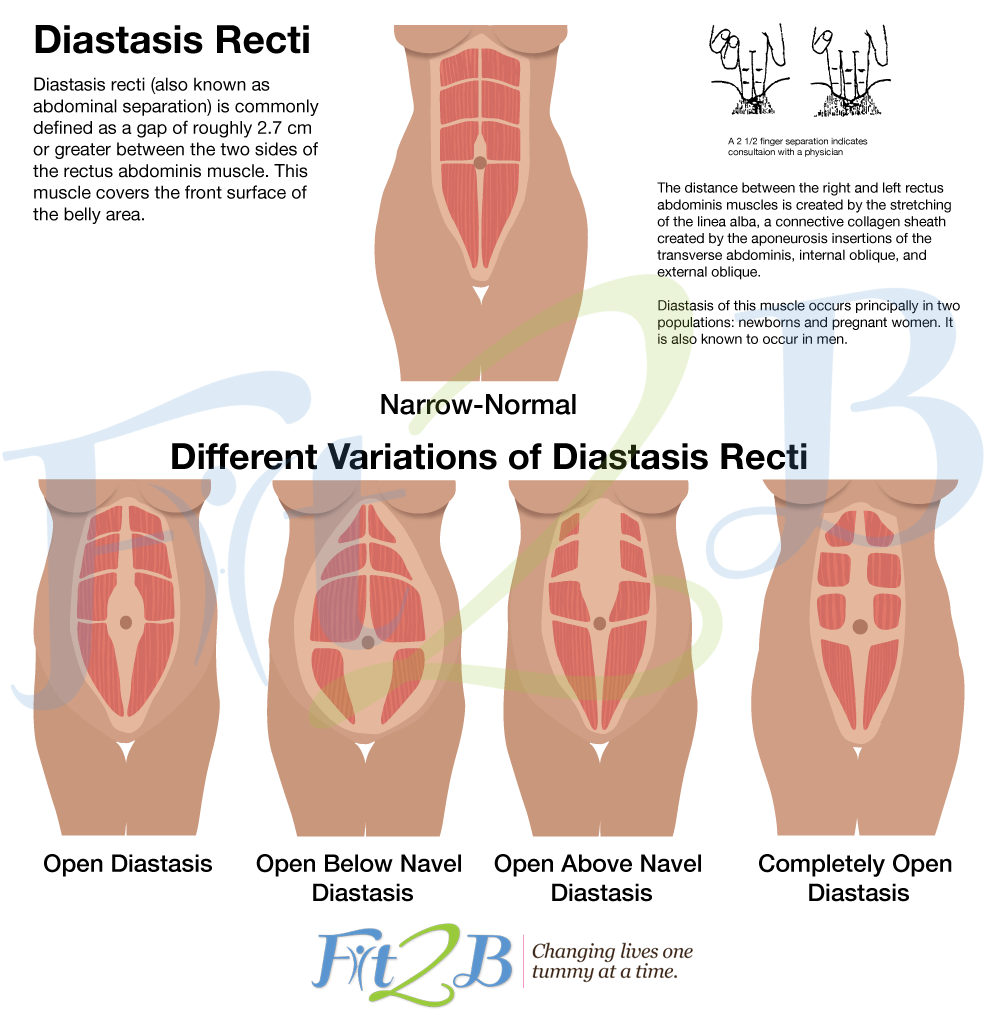 different types of diastasis rectus abdominus - fit2b.com