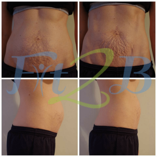 Why does my skin pucker when my diastasis recti starts to close? -fit2b.com