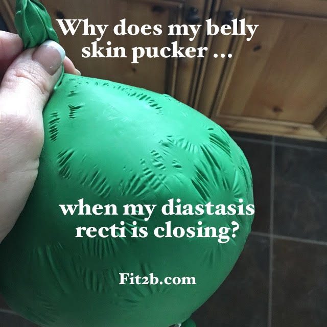 Why Does My Skin Pucker When My Diastasis Recti Narrows? - fit2b.com - Why does my skin pucker when my diastasis recti is closing?