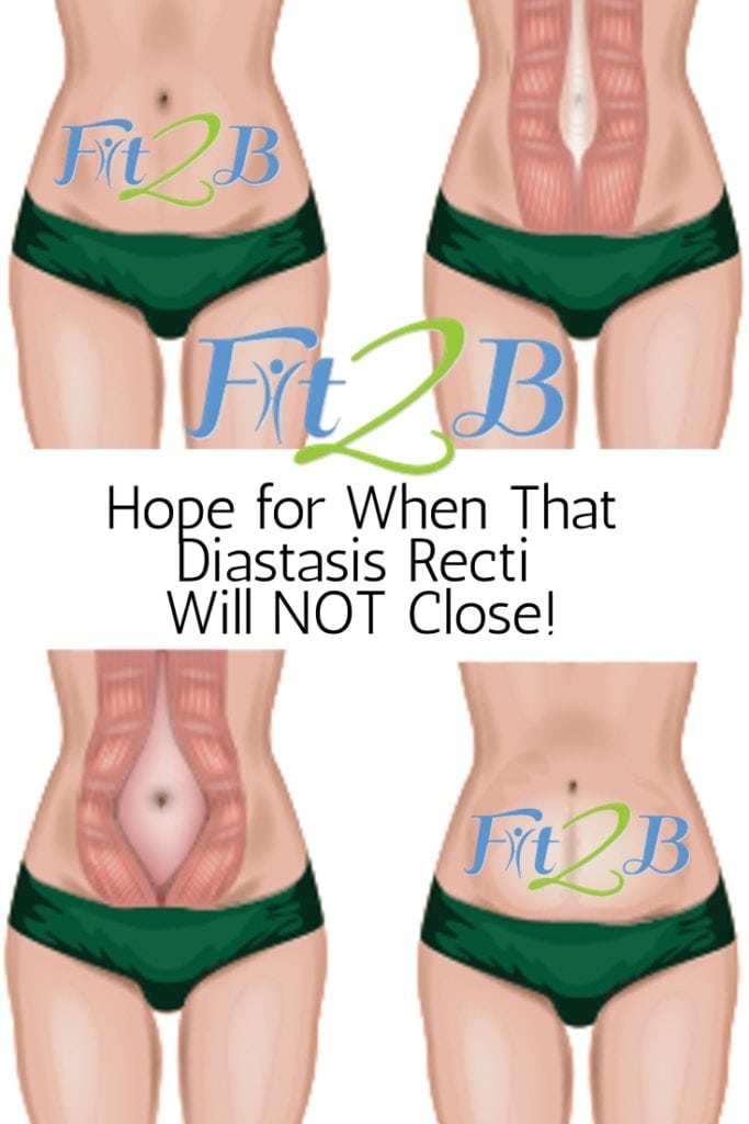 Hope for When That Diastasis Recti Will NOT Close - Fit2B.com - #core #corestregthening #diastasisrectirecovery #mummytummy #fitmom